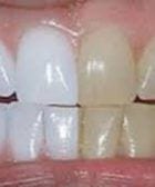 blanqueamiento dental 04 1