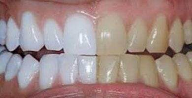 blanqueamiento dental 04 1
