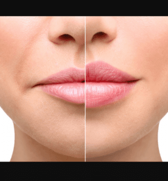 aumento de labios natural 1