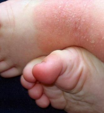 piel atopica en ninos