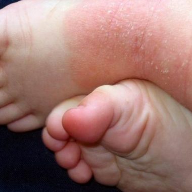 piel atopica en ninos